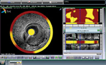 Imagen: TVC Composite (Foto cortesía de  Infraredx).