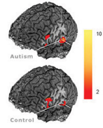 Imagen A: Diferencias entre los cerebros de individuos autistas y control usando RM (Fotografía cortesía del Centro para la Imagenología Cerebral Cognitiva, Universidad Carnegie Mellon)
