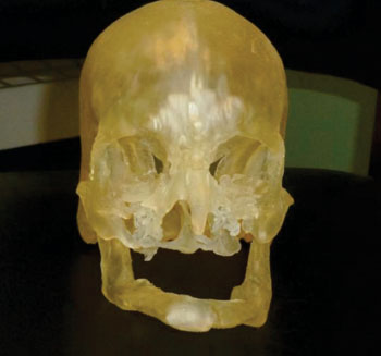 Imagen: Un modelo de impresión en 3-D usado para la planeación quirúrgica (Fotografía cortesía de la RSNA)