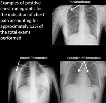 Imagen A: Ejemplos (neumotórax, neumonía redonda, inflamación perihiliar) de radiografías positivas de tórax para la indicación de dolor torácico, representando aproximadamente el 12% de todos los exámenes realizados (Fotografía cortesía de la RSNA).