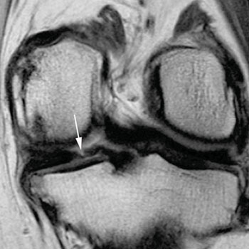 Imagen B: Ejemplos de desgarros del menisco y situación después de la cirugía. La imagen coronal con densidad de protones muestra otro ejemplo de un desgarro, el cual representa un desgarro vertical del cuello posterior del menisco medio (flecha) (Fotografía cortesía de la RSNA).
