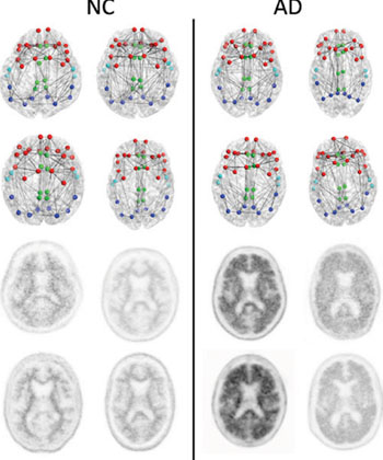 Imagen: Conectomas estructurales (dos hileras superiores) y las imágenes PET con florbetapir correspondientes (dos hileras inferiores) en cuatro pacientes con cognición normal (CN) con la carga más baja de amiloide en la corteza (izquierda) y los cuatro pacientes con EA con la carga más alta de amiloide en la corteza (derecha) enfocada en las regiones compuestas usadas en el conectoma versus el análisis de amiloide. Los nodos representan los centroides de las parcelaciones FreeSurfer en las regiones frontal (rojo) cingulada (verde), temporal (azul claro) y parietal (azul oscuto). Esto solo es un esquema que busca mostrar los conceptos y no busca mostrar ningún tipo de diferencia generalizable discernible visualmente entre los pacientes con CN y aquellos con EA. La métrica de la red estructural suministra información más sensible sobre el conectoma de las que son aparentes a través de la sola visualización (Fotografía cortesía de la RSNA).