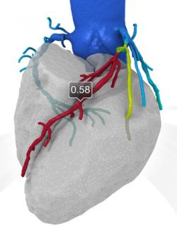 Imagen: Una representación en 3-D del corazón y de las arterias coronarias (Fotografía cortesía de HeartFlow).