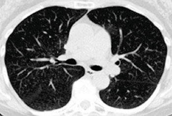 Imagen A: Una imagen de tomografía computarizada del tórax que muestra los pulmones (Fotografía cortesía del Hospital General de Massachusetts).