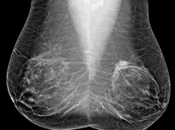Imagen A: Visiones oblícuas mediolaterales, bilaterales (MLO) de las mamografías de cribado (Fotografía cortesía de la RSNA).