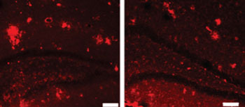 Imagen: Anomalías de placa en el cerebro de un ratón (izquierda), y el tejido cerebral tratados con ultrasonido enfocado guiado por RM (derecha) (Fotografía cortesía de Kullervo Hynynen, Instituto de Investigación Sunnybrook).