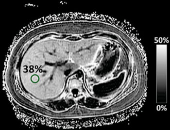 Imagen: Una resonancia magnética de hígado graso no alcohólico grave en el hígado de un niño con un 38% de grasa (1% es normal) (Fotografía cortesía de UCSD).