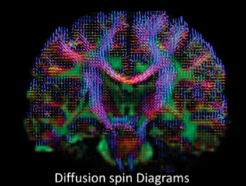Imagen: Una resonancia magnética de alta definición de la difusión del agua, para el estudio de la lesión cerebral traumática (Fotografía cortesía de Sudhir Pathak y Walter Schneider/Universidad de Pittsburgh).