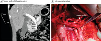 Imagen: Una imagen de resonancia magnética de un tumor de páncreas y la sutura intraoperatoria (Fotografía cortesía de la revista JAMA Surgery).