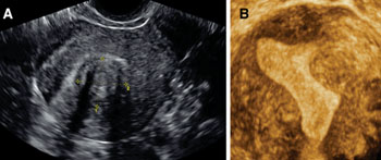 Imagen: Un fibroide submucoso visto usando ultrasonido en 2-D y 3-D (Fotografía cortesía de Benacerraf, Am J Obstet Gynecol 2015).