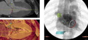 Imagen: El software 3mensio Structural Heart; Septal Crossing (Fotografía cortesía de Pie Medical Imaging).