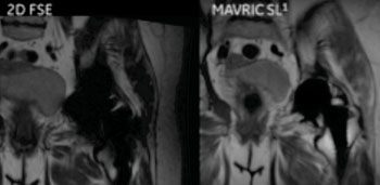 Imagen: Una comparación de las imágenes de la cadera utilizando Fast Spin Eco (FSE) en 2-D y la herramienta para imágenes MAVRIC SL (Fotografía cortesía del Hospital de Cirugía Especial, Nueva York, NY, EUA).