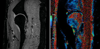 Imagen: Con la imagenología de Siemens de 7-T se pueden obtener imágenes de la capa fina del cartílago y de la forma esférica de la cadera (Fotografía cortesía del Instituto Erwin L. Hahn para la RM, Essen, Alemania).