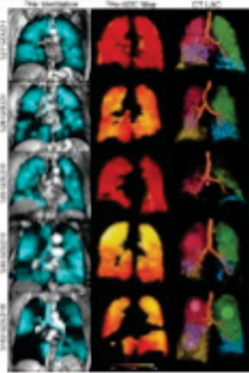 Imagen: Imágenes de pacientes representativos de la enfermedad pulmonar obstructiva crónica (EPOC) leve a moderada y grave. (Fotografía cortesía de la RSNA).