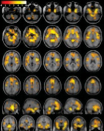Imagen: Una imagen ponderada con RM en T1 de un cerebro, que muestra un volumen de materia gris significativamente mayor en los sujetos sanos de control que en las mujeres con dependencia a las drogas (Fotografía cortesía de la RSNA).