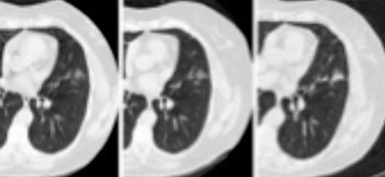 Imagen: Tres imágenes de tomografía computarizada (TC) que muestran un adenocarcinoma invasivo del pulmón (Fotografía cortesía de la RSNA).