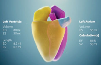 Imagen: El modelo cardiaco usado en el Philips HeartModelA.I (Fotografía cortesía de Royal Philips).