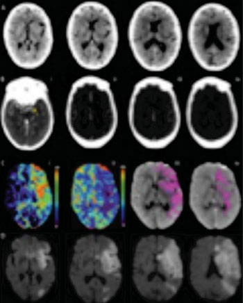 Imagen: Imágenes multimodales de TC obtenidas 2 horas y 18 minutos después del inicio de los síntomas en una mujer de 87 años de edad, con una Escala de apoplejía del NIH de 15 y síntomas del hemisferio izquierdo (Fotografía cortesía de la revista Radiology y de la RSNA 2015).