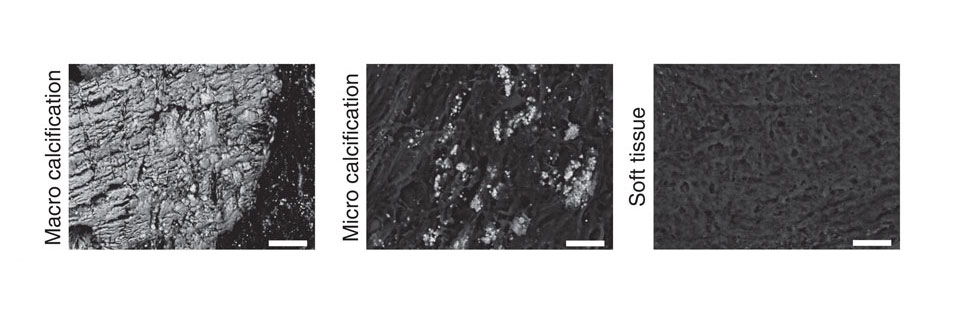 Imágenes con microscopio electrónico de barrido (SEM) de las etapas de calcificación de la placa (Imagen cortesía de la Universidad de Cambridge).