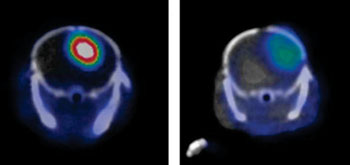 Imagen: Un glioblastoma en un escaneo de PET con (izquierda) y sin (derecha) el marcador YY146 (Fotografía cortesía de Weibo Cai, WISC).