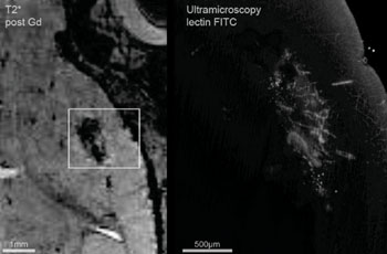 Imagen: Las imágenes de RM y de UM correlacionadas tres semanas después de la implantación del tumor GL261 (Fotografía cortesía de eLife).