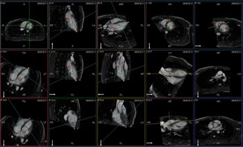 Imagen: Vistas cardíacas SCMR con el sistema Vantage Titán/cS edition de resonancia magnética de 1,5 T de Toshiba (Fotografía cortesía de Toshiba Medical Systems).