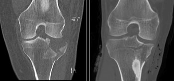Imagen: TC con dosis de radiación ultra-baja de una fractura de la meseta tibial en comparación con una dosis de TAC convencional (Fotografía cortesía del Centro Médico Langone de la NYU).