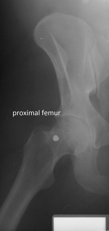 Imagen: La fractura concordante en el fémur proximal (Fotografía cortesía de Ann Ross/NCSU).