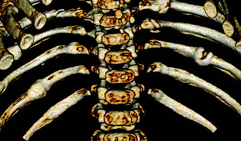 Imagen: Una reconstrucción en 3D de un niño con diversas fracturas de costillas que podría ser utilizada por los profesionales de la salud para los casos de abuso infantil (Fotografía cortesía de Sabah Servaes, MD).