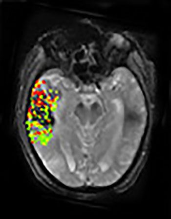 Imagen: La imagen muestra imágenes por resonancia magnética de un paciente, tomadas antes y después del tratamiento, y pone de manifiesto la correlación entre el área y el tamaño de la hemorragia después del tratamiento, y la alteración de la barrera hematoencefálica antes de la terapia (Fotografía cortesía del Dr. Leigh, NINDS).