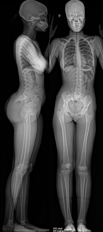 Imagen: Una imagen de rayos X, de cuerpo entero, producida por el escáner de imagenología EOS (Fotografía cortesía de EOS Imaging).
