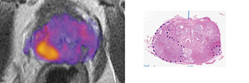 Imagen: La imagen de la izquierda es la imagen de resonancia magnética (RM) de una próstata, mejorada mediante la adquisición de imágenes con espectro de restricción (RSI). El tumor de más alto grado se indica con naranja y amarillo. La imagen de la derecha es un corte digitalizado de la próstata, con los tumores señalados con líneas de puntos azules (Fotografía cortesía del Servicio Médico de la Universidad de California en San Diego).