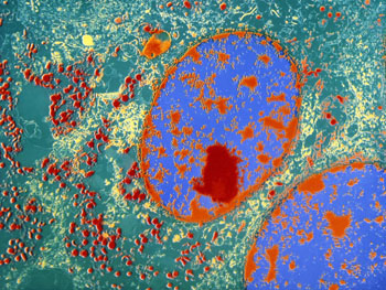 Imagen: Las células de un tumor neuroendocrino (Fotografía cortesía de MedScape).