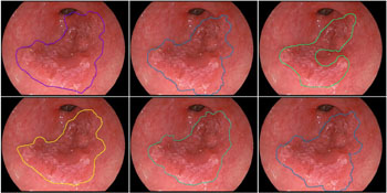 Imagen: Contornos de cáncer esofágico precoz, elaborado por especialistas, en comparación con el contorno dibujado por el algoritmo del ordenador (parte superior derecha) (Foto cortesía de la Universidad Tecnológica de Eindhoven).