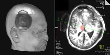 Imagen: Una reconstrucción en 3D de la cabeza de un paciente con el transductor (Izquierda); vista axial del transductor y el objetivo aproximada del tálamo (Derecha) (Fotografía cortesía de Martin Monti/UCLA).