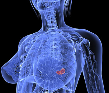 Imagen: El cáncer de mama mostrado en 3D (Fotografía cortesía de la FDA de los EUA).