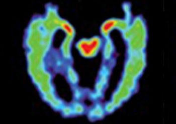 Imagen: Un estudio TEP de un cerebro con sospecha de CTE; los colores rojo y amarillo indican proteínas anormales del cerebro (Fotografía cortesía de la UCLA).