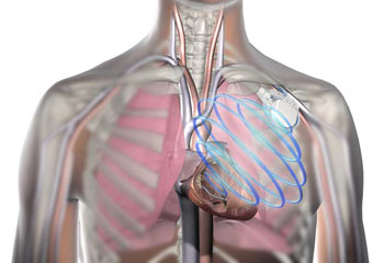 Imagen: La monitorización del estado de los líquidos OptiVol para monitorizar la falla cardiaca en el pacientes con un ICD de Medtronic (Fotografía cortesía de Medtronic).