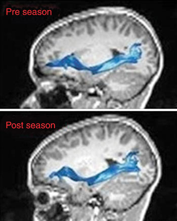 Imagen: Las RM son del fascículo fronto-occipital izquierdo, inferior, antes y después de la temporada de juego de fútbol americano (Fotografía cortesía de la RSNA).