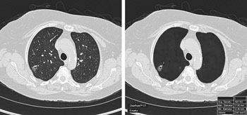 Imagen: El ClearRead CT suprime las estructuras pulmonares para identificar los nódulos (Fotografía cortesía de Riverain Technologies).