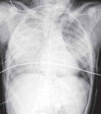 Imagen: Una radiografía AP del pecho, de un adolescente de 16 años, implicado en un volcamiento de un vehículo todo terreno (Fotografía cortesía de Radiology Key).