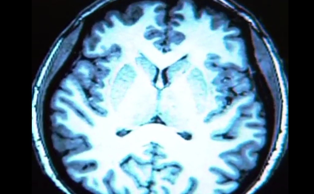Imagen: Un ejemplo de un examen de resonancia magnética del cerebro utilizado en el estudio (Fotografía cortesía de la RSNA).