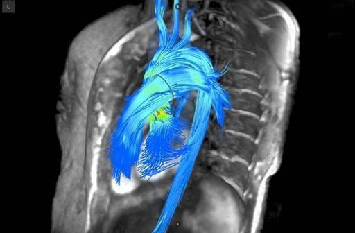 Imagen: Una imagen generada por el software de cuantificación de flujo cardíaco 4D Arterys (Fotografía cortesía de Arterys).