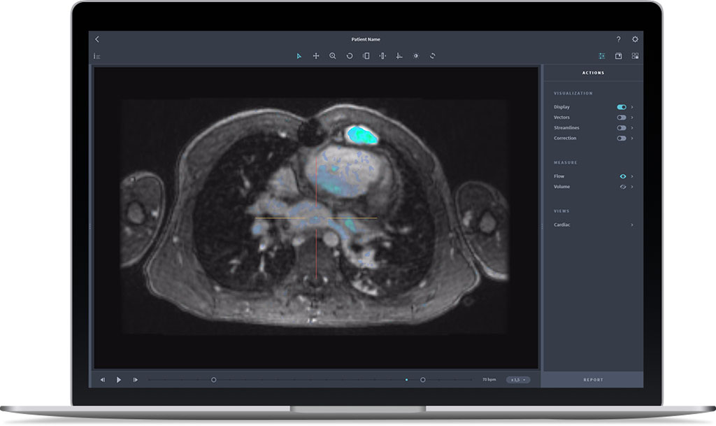 Imagen: El ViosWorks utiliza exámenes de resonancia magnética para analizar la función cardíaca (Fotografía cortesía de Arterys).
