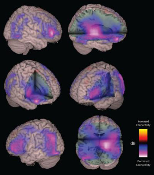 Imagen: La magnetoencefalografía (MEG) también se usa en pacientes con sospecha de lesiones cerebrales (Fotografía cortesía de la Universidad de California, San Francisco).