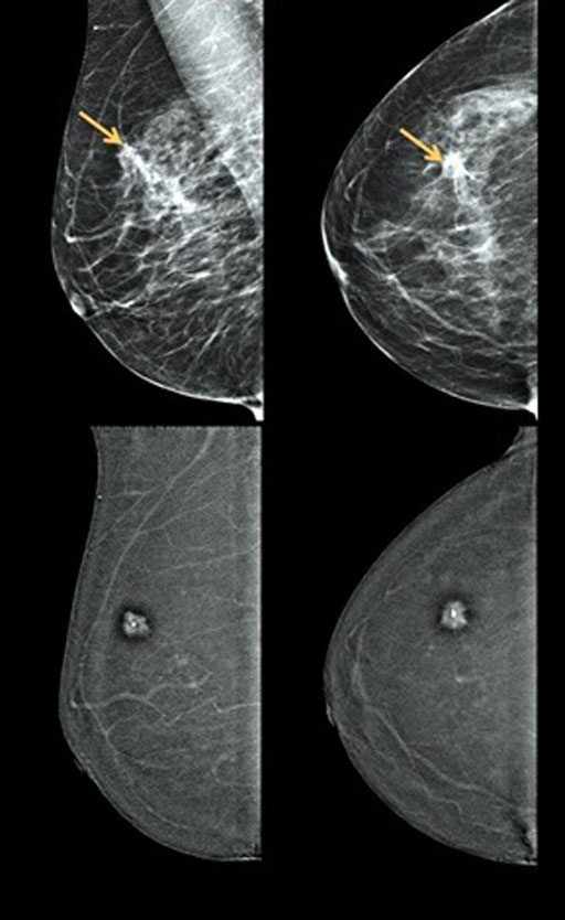 Imagen: Mammogramas digitales (parte superior) comparados con las imágenes de la Mamografía Digital Realzada por Contraste (CEDM) (parte inferior) para el cribado del cáncer de mama (Fotografía cortesía del Dr. John Lewin).