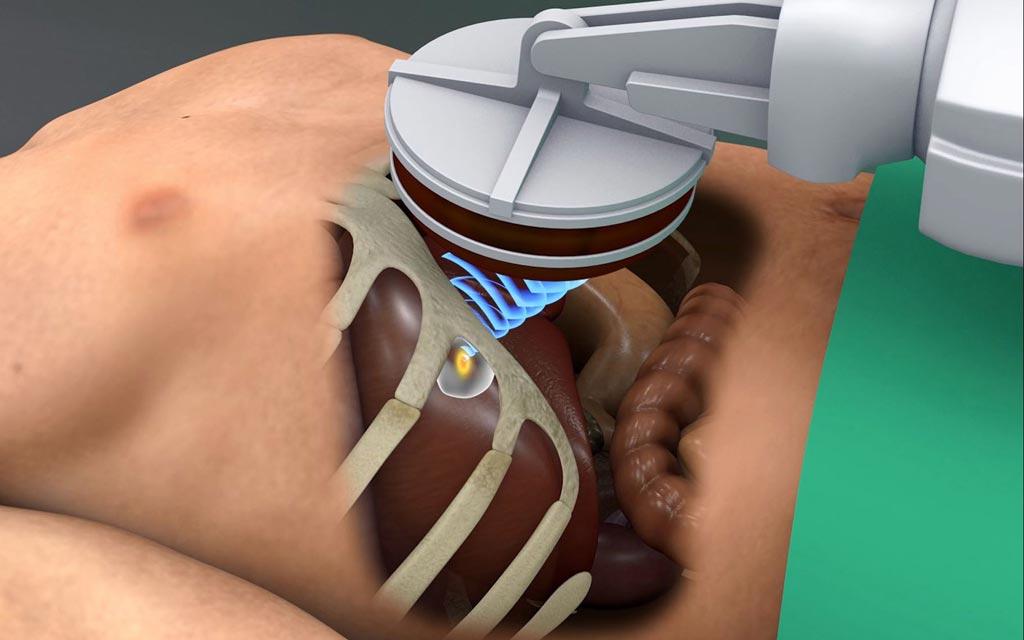Imagen: El ultrasonido focalizado podría tratar tumores en los órganos en movimiento, como el hígado (Fotografía cortesía de Fraunhofer MEVIS).
