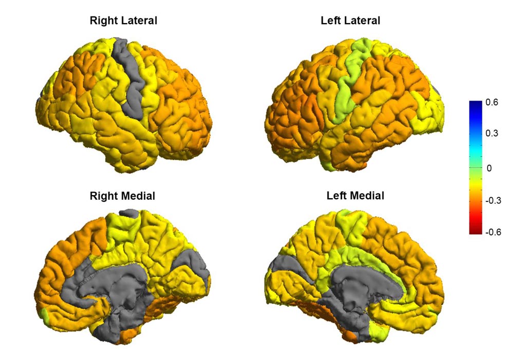 Imagen: La investigación demuestra que los pacientes bipolares tienden a tener reducciones de la materia gris en las regiones cerebrales frontales involucradas en el autocontrol (colores naranjas), mientras que las regiones sensitivas y visuales son normales (colores grises) (Fotografía cortesía del Consorcio Bipolar ENIGMA/Derrek Hibar et al.).