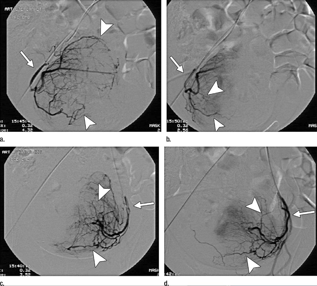 Imagen: Las imágenes de la angiografía de substracción digital muestran el progreso de los tratamientos parciales de la Embolización de los Fibromas Uterinos (UFE) (Fotografía cortesía de la RSNA).