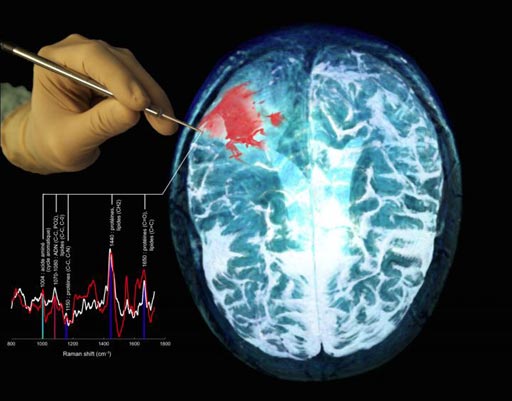 Imagen: Una representación de la nueva sonda multimodal en uso durante la cirugía, junto con un examen de resonancia magnética (RM) de un paciente con cáncer de cerebro que muestra el tumor en rojo (Fotografía cortesía de Frédéric Leblond y Kevin Petrecca).